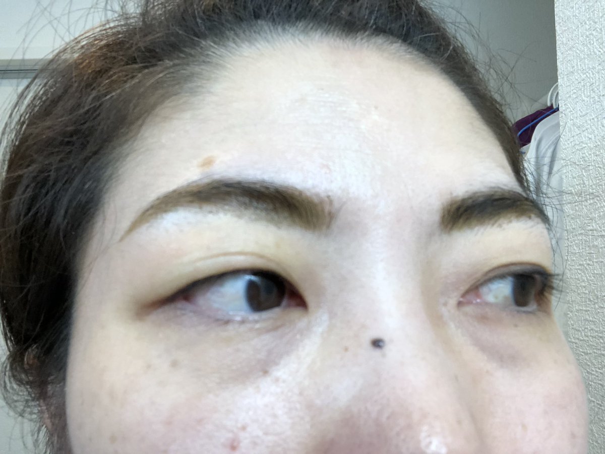 まぶたのかぶれ