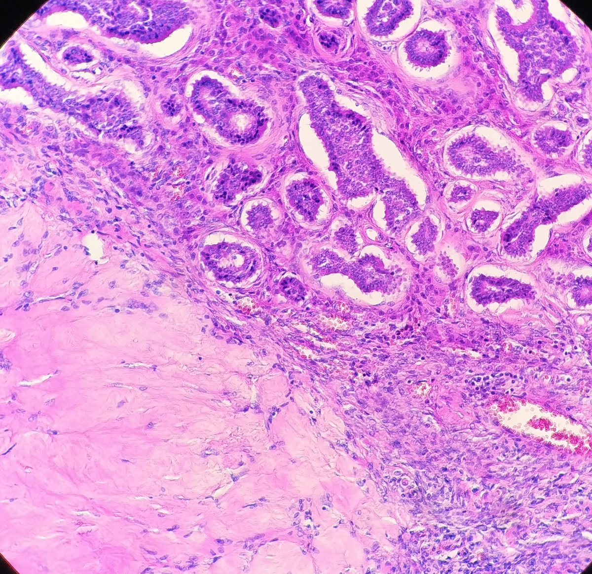SBaksuz's tweet photo. Ovarian insular carcinoid. #pathology #histology #ginpath #pathologists https://t.co/1HJSibuHst