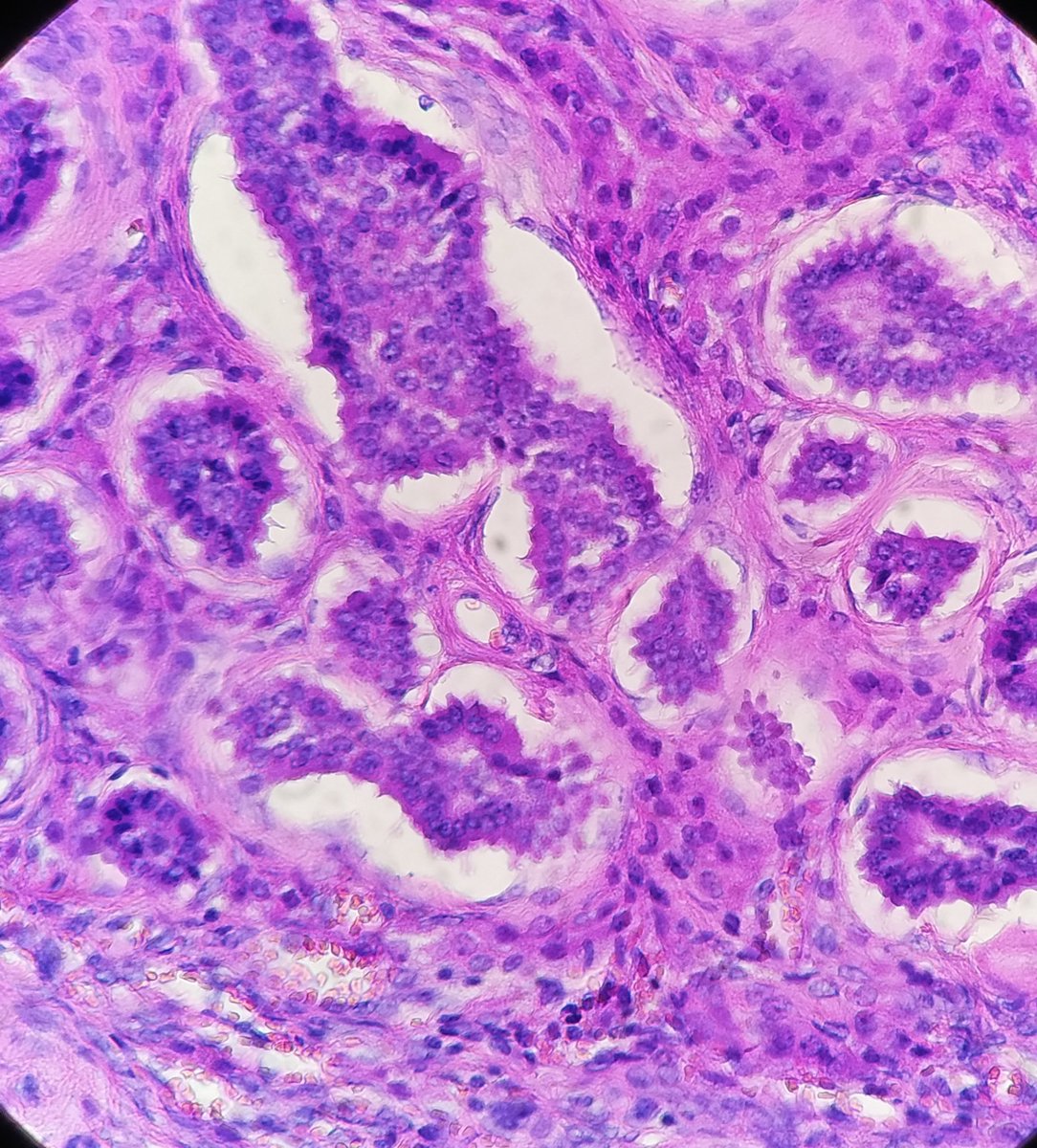 SBaksuz's tweet photo. Ovarian insular carcinoid. #pathology #histology #ginpath #pathologists https://t.co/1HJSibuHst