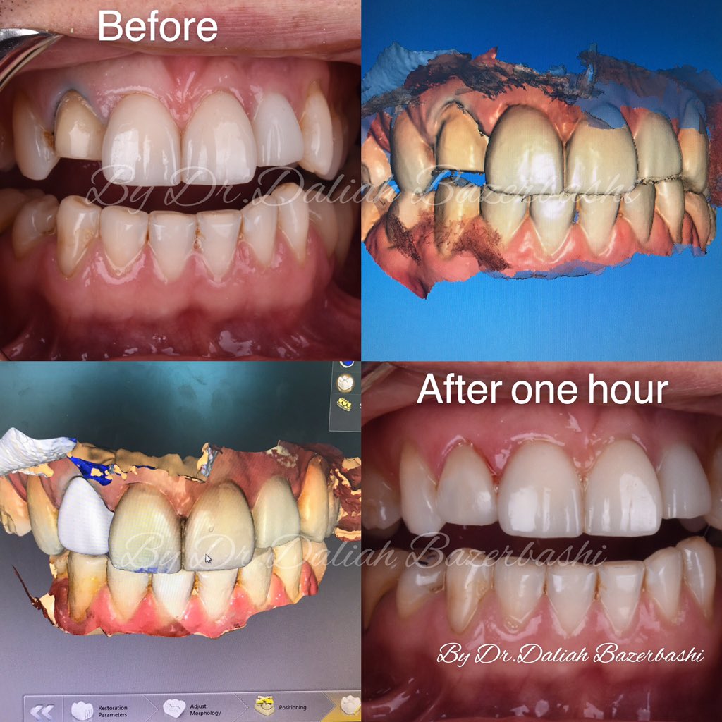 daliah_dr's tweet photo. After one hour,  I provided the patient a new veneer by using the dental digital scanner.

#dentist #dental #dentistry #dentista #veneers #emax #teeth #hollywoodsmile #odontologia #teethwhitening #dentistrylife #dentistrylove #smiledesign #dubai #dubailove #uae #ksa https://t.co/LscPNn0wFf