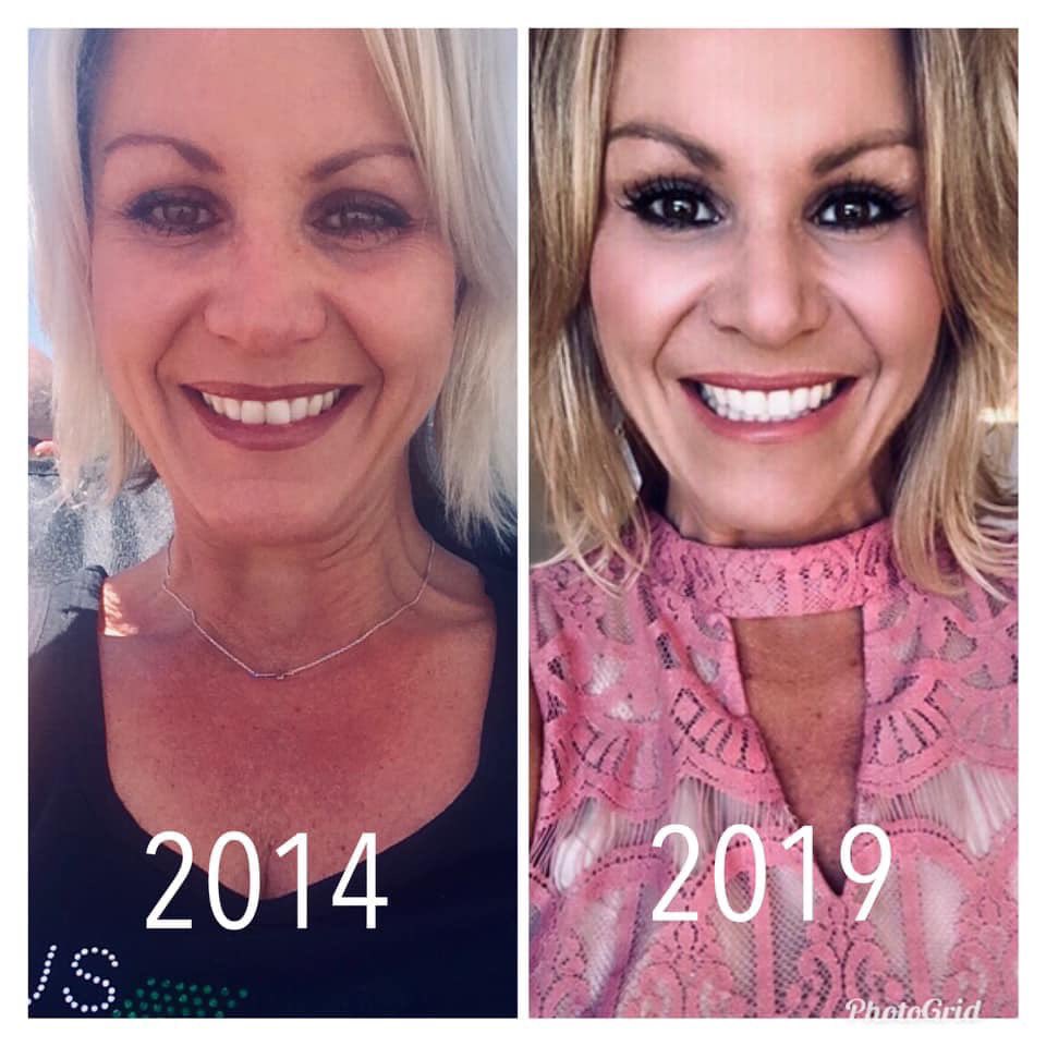 Can u c how great my friend Helen looks? When you’re on amazing gut health products & make healthy living a priority getting older ain’t so scary afterall #thatwas47 #thisis52 #plexus #invisalign #waterallday #joyomeskinscience #nosecrets #noshortcuts #nodiets