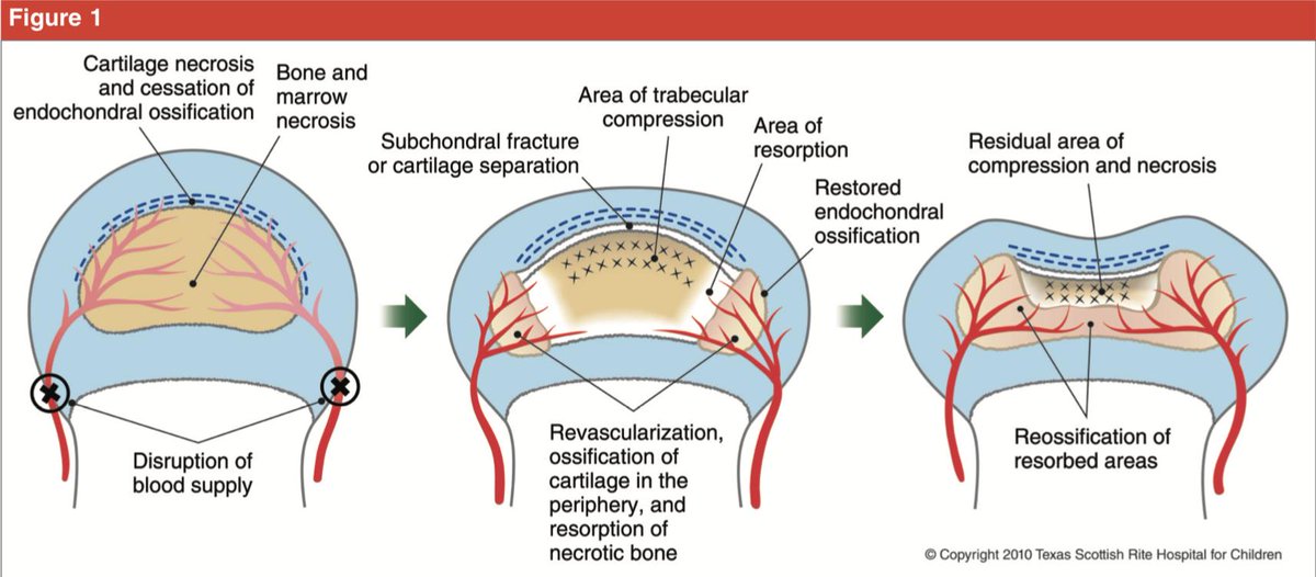 DrJoelGambin's tweet photo. 👉💡 En 1910 tres médicos diferentes (Legg AT, Calvé J, Perthes G) comentaron por primera vez una "extraña afección de la cadera" #cursocot #capítulo52 #AAOS #currentconceptsreview
https://t.co/fzytHrTult https://t.co/ka5yaL4ZV2