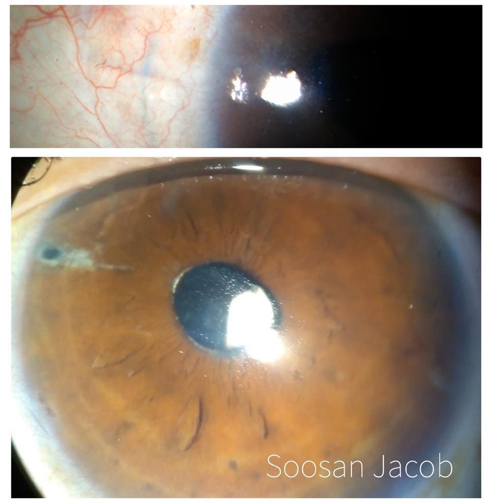 drsoosanjacob's tweet photo. 3 years post op picture of subluxated cataract operated with my technique of supracapsular glued IOL. Video: https://t.co/jVMMfNsM7O #cataract #phaco #phacoemulsification #cataractsurgery #gluediol #subluxated https://t.co/Nal9MnTCDO