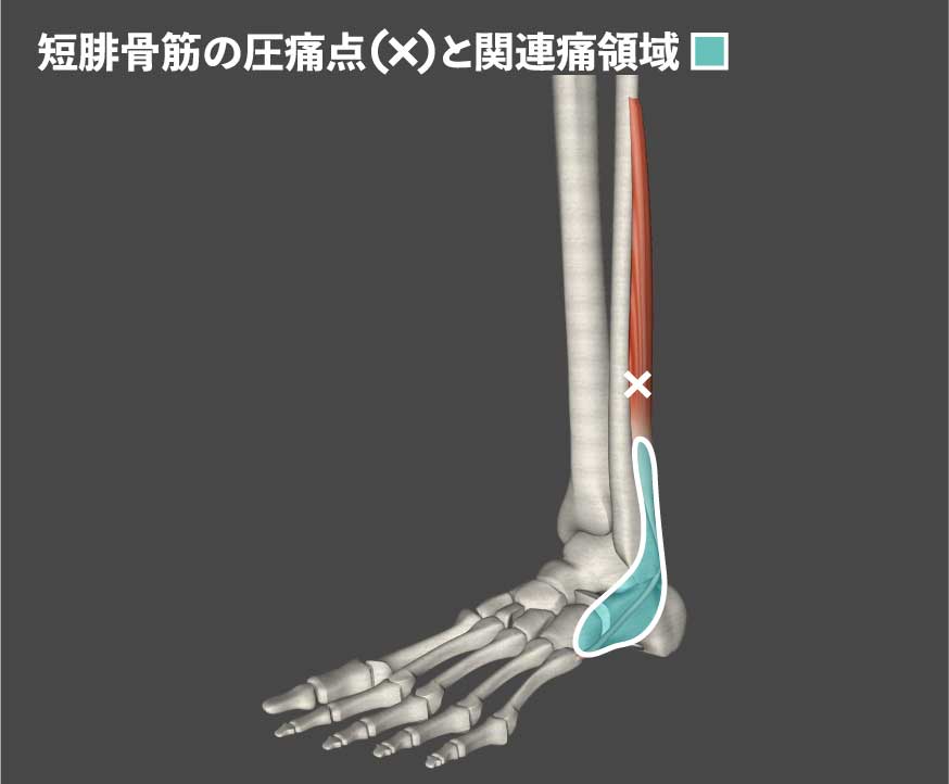 中尾浩之 リハトラ در توییتر 正座したら足首の外側が痛いケースでは短腓骨筋の硬結が認められるケースが多い 捻挫後遺症