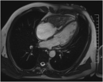 HumanPathReport's tweet photo. Late isolated metastasis of colon adenocarcinoma to the right ventricle #CardiacPath #GIPath
https://t.co/KpuspmQ3tD
@NRiddleMD @ALBoothMD @RaulSGonzalezMD @Chucktowndoc https://t.co/fPpFzVTr0C