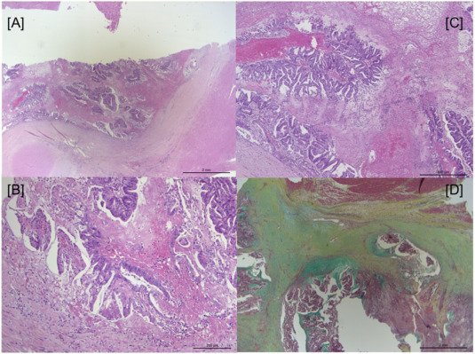 HumanPathReport's tweet photo. Late isolated metastasis of colon adenocarcinoma to the right ventricle #CardiacPath #GIPath
https://t.co/KpuspmQ3tD
@NRiddleMD @ALBoothMD @RaulSGonzalezMD @Chucktowndoc https://t.co/fPpFzVTr0C