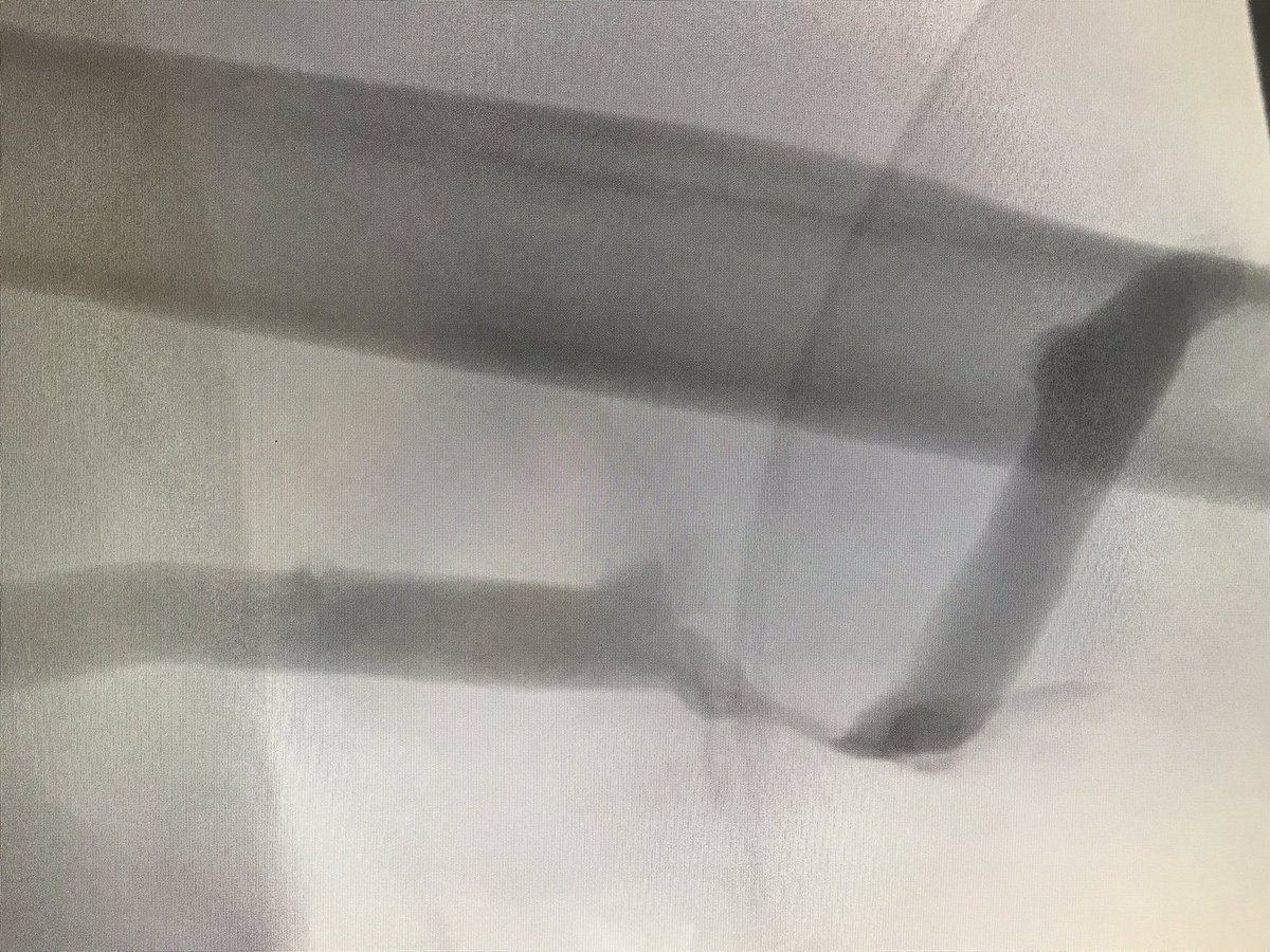 wasse_m's tweet photo. ππ½What size balloon r u comfortable sizing up to within a bovine mesenteric dialysis AVG?
ππ½At the venous anastomosis?
ππ½ Additional precautions?
#AlwaysReadTheOpNote
@TzeWoeiTan @SamTyagiMD @nick_inston @TheRealDoctorOs @ASDINNews https://t.co/DpK96v1o9N