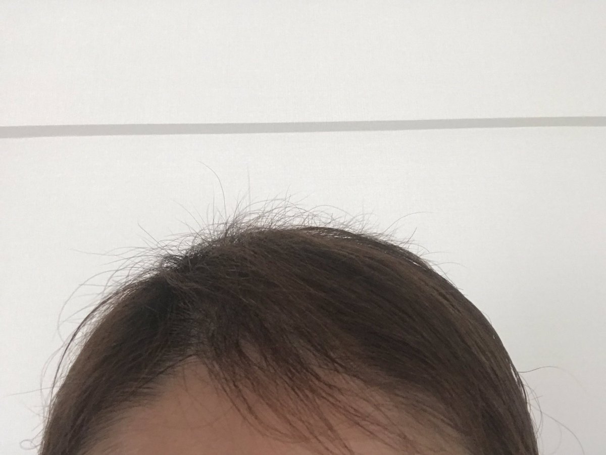 そらぞら 顔周りもすぐ抜けるから薄いなー でも 注目は頭頂部 3センチほどの髪がたくさん いやもちろん 生えてくれるのは嬉しいんだけど 毎朝枕に大量の髪が付いてるから 密かに繰り返してやがるな と思い知ったシャワーの後の出来事