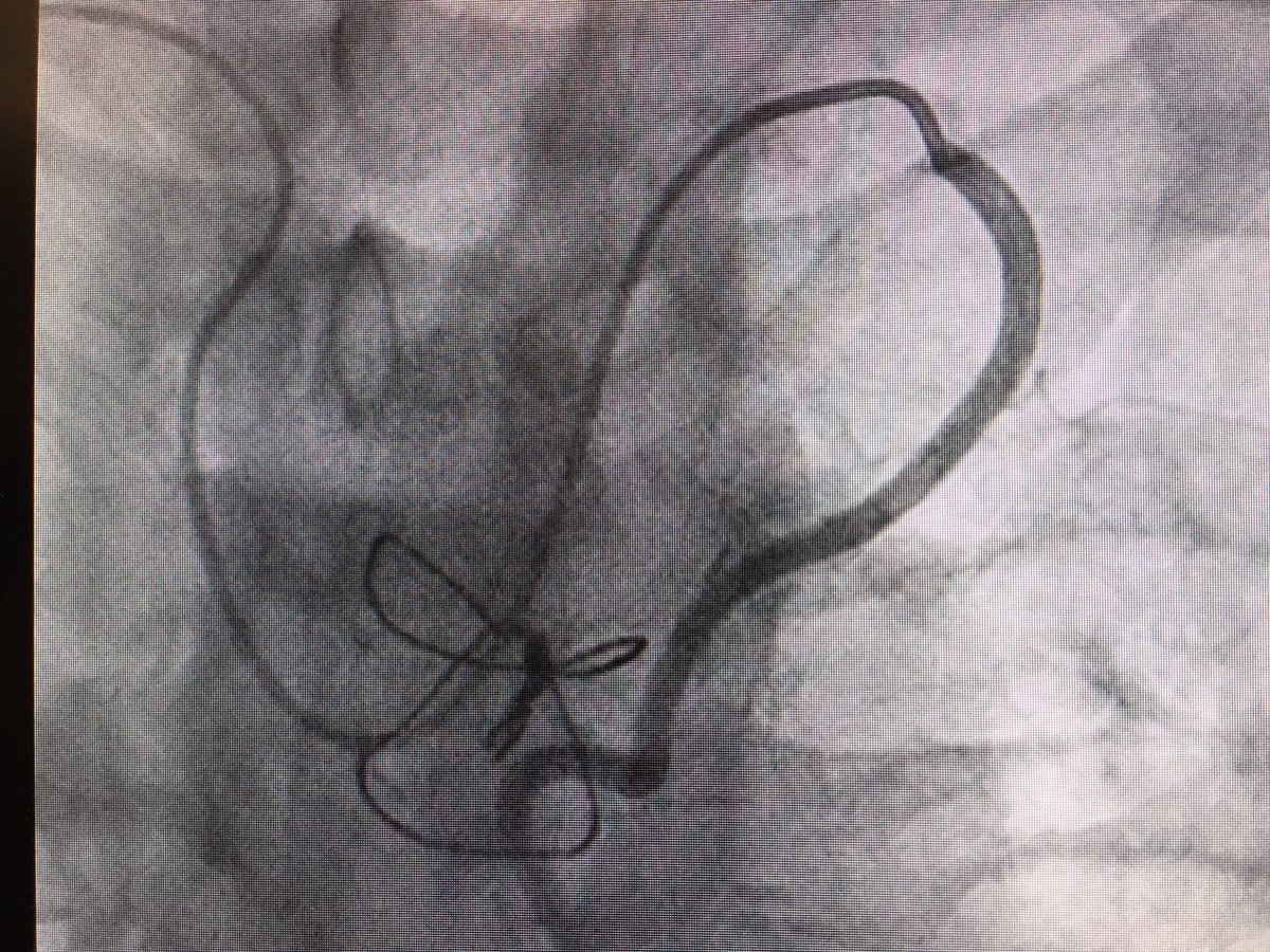 ToulouseAdam's tweet photo. This is a unique one!
Fantastic showcase of the Cordis Tempo Aqua IM Bartorelli-Cozzi diagnostic catheter allowing access to the LIMA via the right radial approach. Tell me about your thoughts/experiences with this approach?
#radialfirst #pci #intervention #access #Radial360 https://t.co/3F5fciojSM