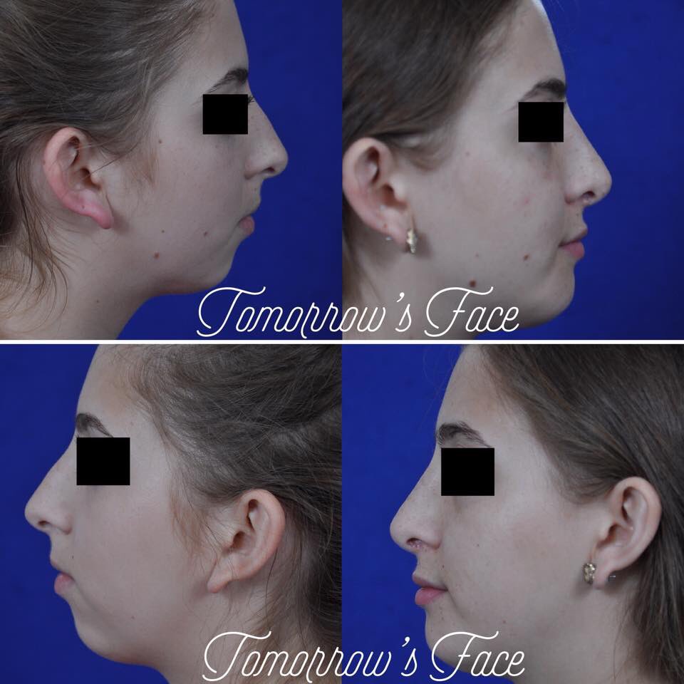 TomorrowsFace's tweet photo. A #Nose that is #over-projected can often dominate the #FacialProfile. #DrMorrow, a skilled #FacialPlasticSurgeon who routinely performs #Cosmetic #Rhinoplasty, can set the nasal tip back & lower the #NasalBridge to match the new tip position. https://t.co/FKbki9N5ss
