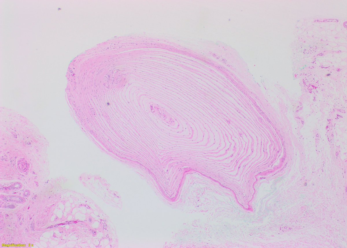 PathTyler's tweet photo. Today we had a nice example of a Pacinian Corpuscle Neuroma. It is a benign lesion composed of prominent pacinian corpuscles with variable patterns in the dermis. Typical corpuscles measure 1.0 - 1.5mm, these were slightly larger at 2mm. #dermpath #dermatology @PathBoards https://t.co/dvzNJ2xtYn