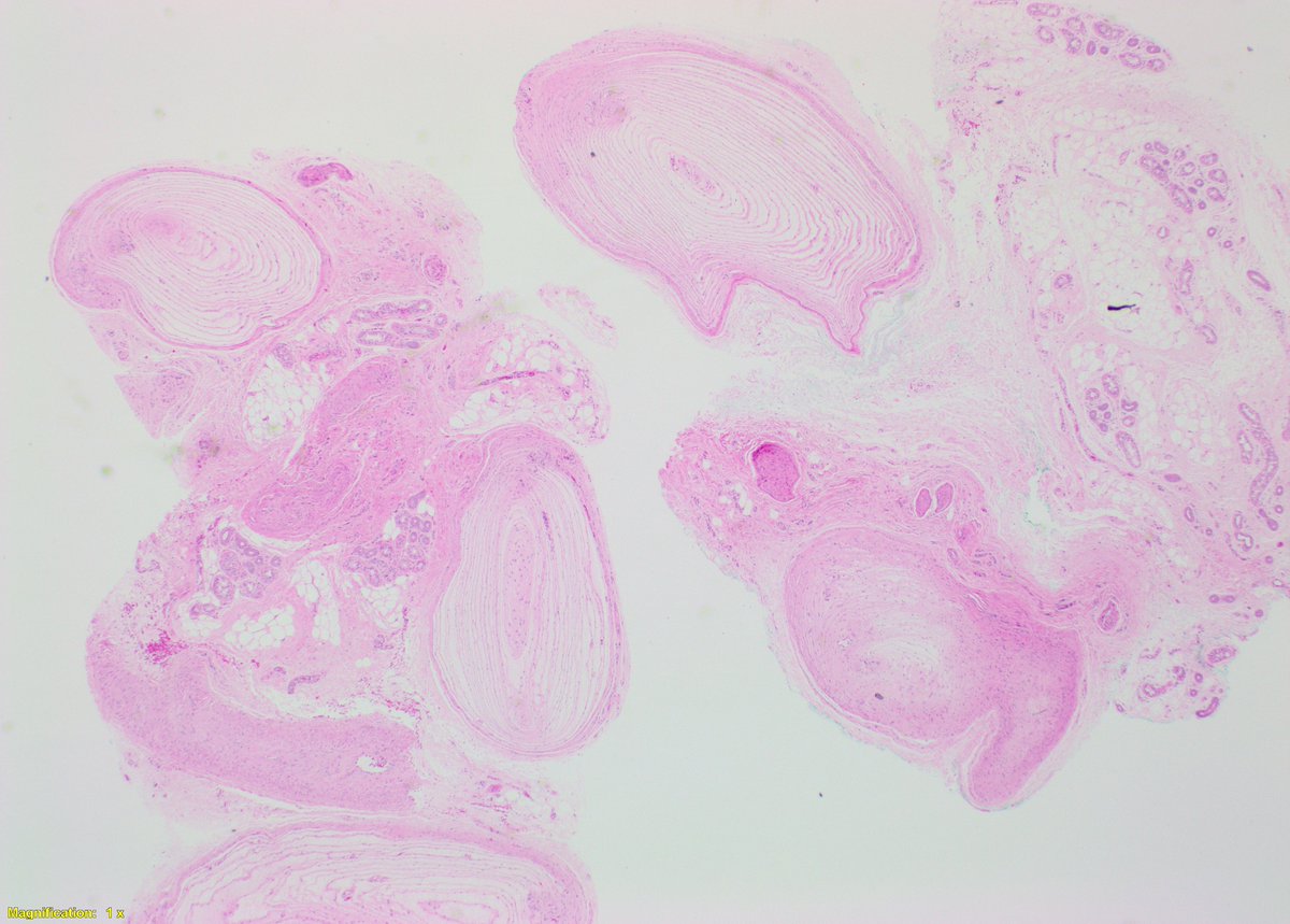 PathTyler's tweet photo. Today we had a nice example of a Pacinian Corpuscle Neuroma. It is a benign lesion composed of prominent pacinian corpuscles with variable patterns in the dermis. Typical corpuscles measure 1.0 - 1.5mm, these were slightly larger at 2mm. #dermpath #dermatology @PathBoards https://t.co/dvzNJ2xtYn