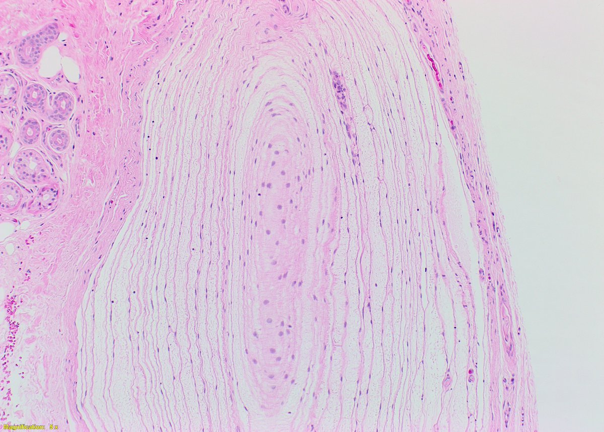 Today we had a nice example of a Pacinian Corpuscle Neuroma. It is a benign lesion composed of prominent pacinian corpuscles with variable patterns in the dermis. Typical corpuscles measure 1.0 - 1.5mm, these were slightly larger at 2mm. #dermpath #dermatology <a href="/PathBoards/">Dr. Pathology Boards</a>