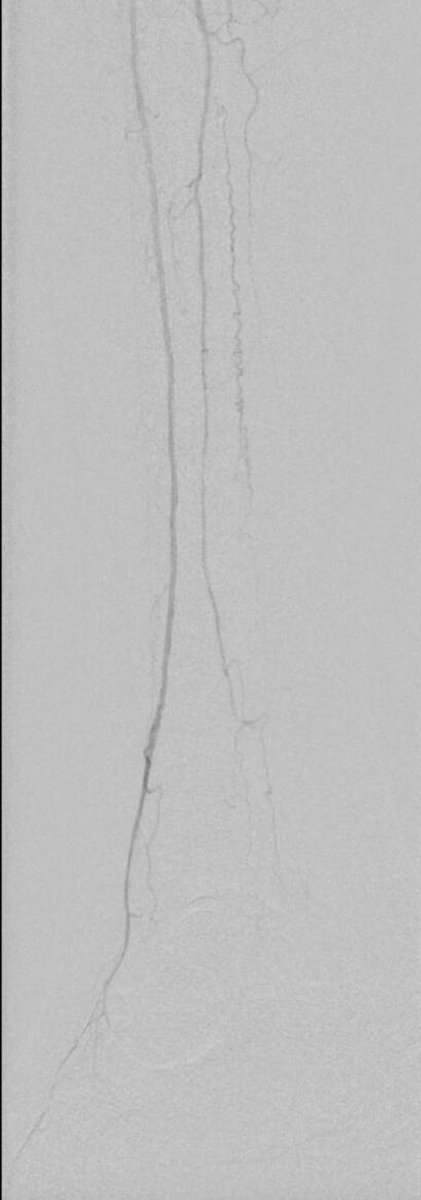 69 year old woman with a history of heart transplant with right great toe gangrene and segmental occlusion in the anterior tibial artery and dorsalis pedis - before and after treatment.