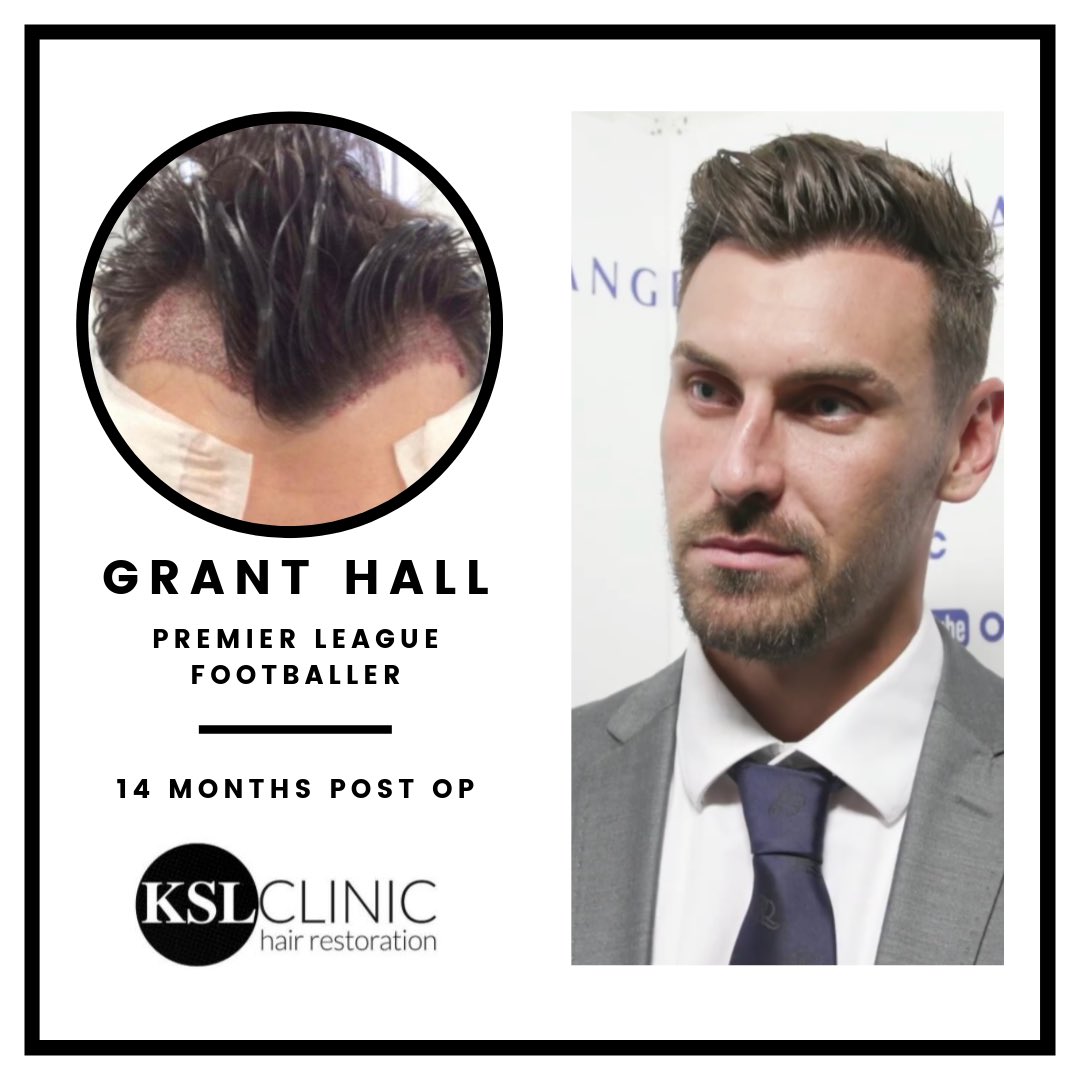 KSL Clinics | Hair Transplant Experts on Twitter: KSL Clinics | Hair Transplant Experts on Twitter: