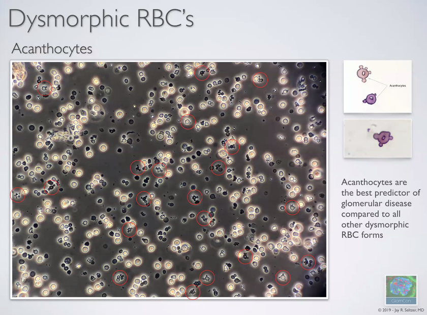 Dysmorphic RBCs or Acanthocytes --> Glomerular origin of hematuria. # ...