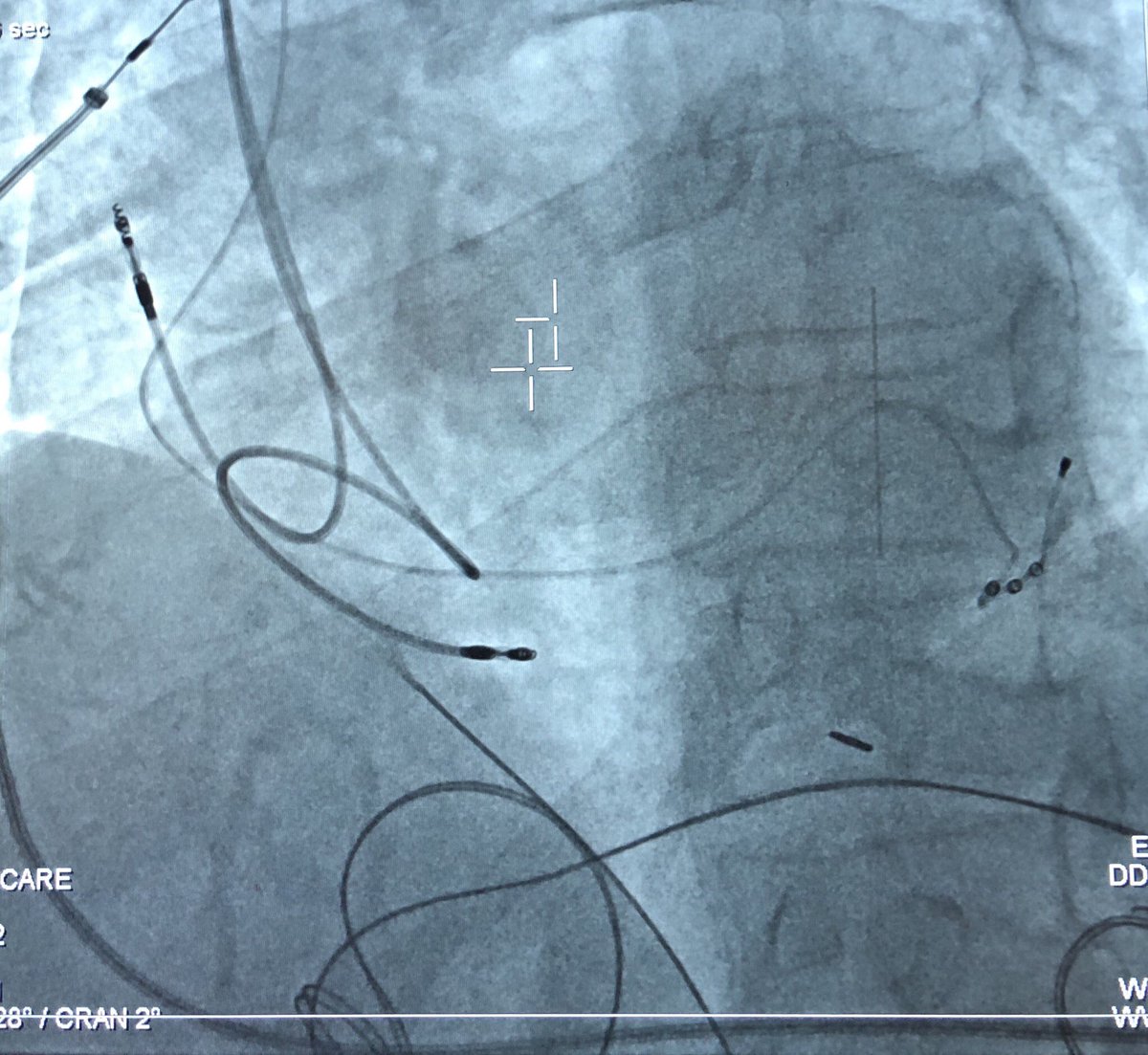 Life2TheFullst's tweet photo. Another successful CRT implant at the University of Colorado with a 38% reduction in QRS! Initial QRS of 163ms down to 101ms achieved only when activating both #MPP and #SyncAV. Nice work by the @Colorado_EP team and @Value_Function representing #AbbottEP #NextLevelCRT https://t.co/VHwORjF9fO