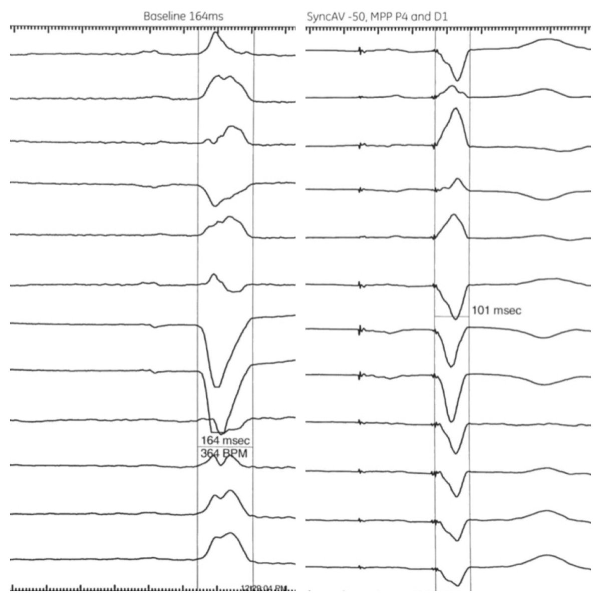 Life2TheFullst's tweet photo. Another successful CRT implant at the University of Colorado with a 38% reduction in QRS! Initial QRS of 163ms down to 101ms achieved only when activating both #MPP and #SyncAV. Nice work by the @Colorado_EP team and @Value_Function representing #AbbottEP #NextLevelCRT https://t.co/VHwORjF9fO