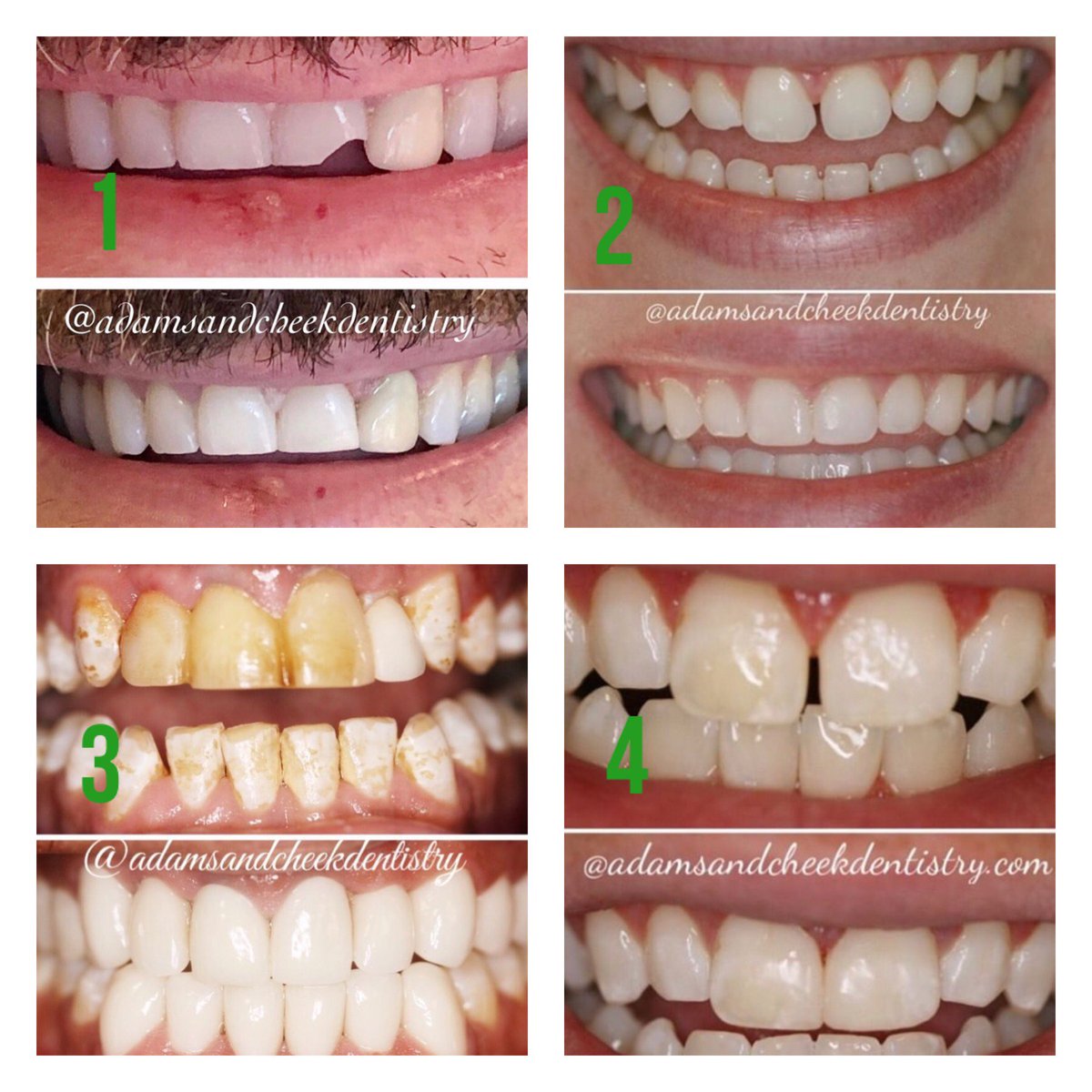 AdamsCheekDDS's tweet photo. Ok - it's a big #TransformationTuesday! Why? Because you get to vote! Which transformation do you think is the best one? We can't wait to see which one gets the most votes. #NewSmile #BigTransformation https://t.co/2FYi9gPRNr