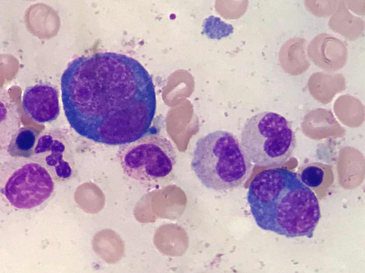 Fer_martinmoro's tweet photo. Bi and multinucleated erythroblasts seen in a bone marrow sample of a patient diagnosed by MDS with multilineage dysplasia
#CytoPath #HemePath #dysplastic https://t.co/nfU0Pl9LTq
