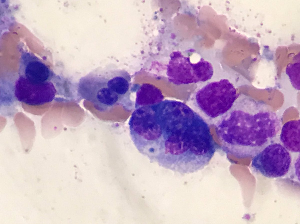 Fer_martinmoro's tweet photo. Bi and multinucleated erythroblasts seen in a bone marrow sample of a patient diagnosed by MDS with multilineage dysplasia
#CytoPath #HemePath #dysplastic https://t.co/nfU0Pl9LTq