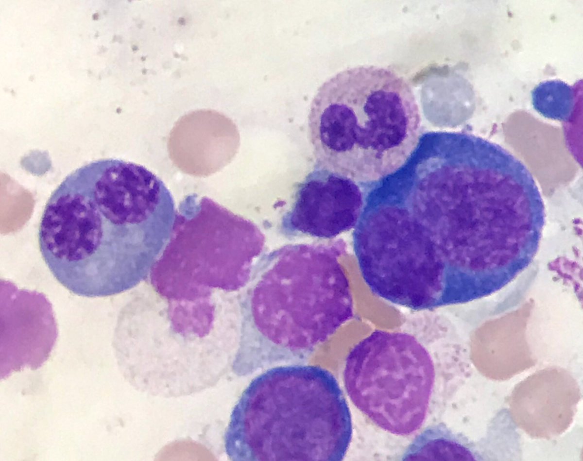 Fer_martinmoro's tweet photo. Bi and multinucleated erythroblasts seen in a bone marrow sample of a patient diagnosed by MDS with multilineage dysplasia
#CytoPath #HemePath #dysplastic https://t.co/nfU0Pl9LTq