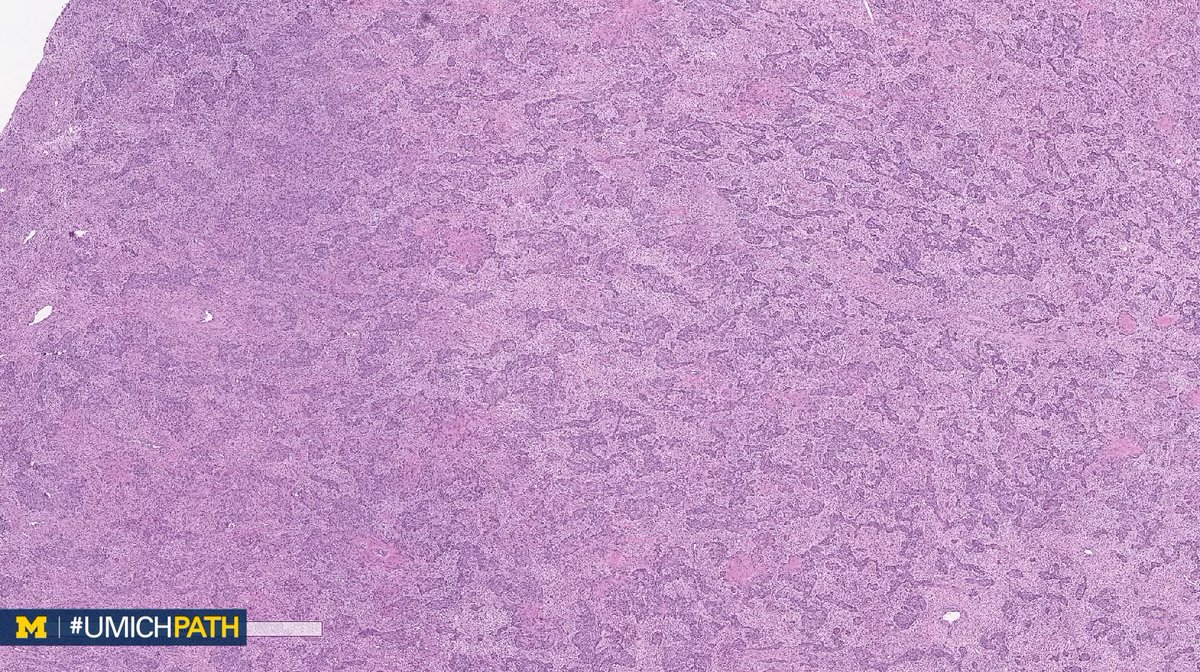UMichPath's tweet image. A: Uterine tumors resembling ovarian sex cord tumors (UTROSCT). A rare mesenchymal tumor with epithelial-like cells resembling ovarian sex cord tumors. IHC: Sex cord markers are specific, but not always positive. CD10 frequently positive. #GYNPath #DailyDx (H/T 
@Eggmcmullen)