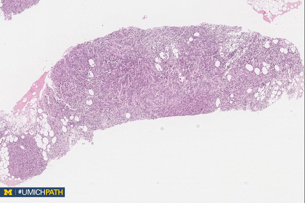 UMichPath's tweet image. 🔬#BreastPath, Day 2

➡️What’s your #DailyDx of this breast core biopsy?

➡️What stain is typically positive, and what recurrent genetic alteration is associated?

➡️We’ll tweet the answers, some quick facts, and the next case tomorrow! #UMichPath