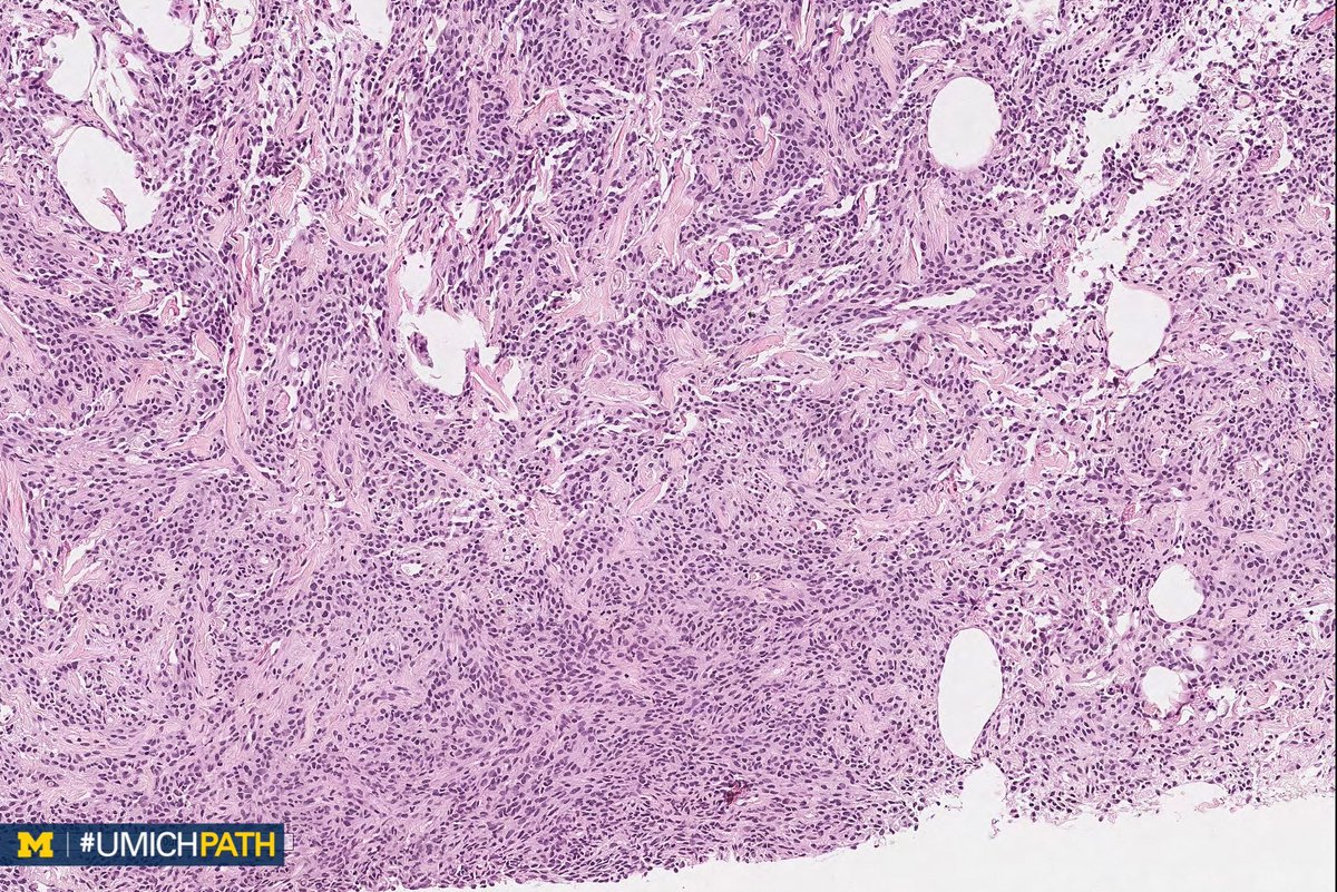 UMichPath's tweet image. 🔬#BreastPath, Day 2

➡️What’s your #DailyDx of this breast core biopsy?

➡️What stain is typically positive, and what recurrent genetic alteration is associated?

➡️We’ll tweet the answers, some quick facts, and the next case tomorrow! #UMichPath