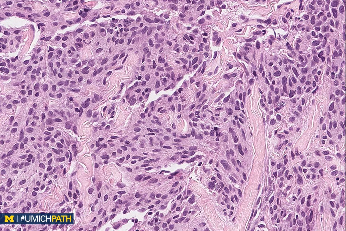 UMichPath's tweet image. 🔬#BreastPath, Day 2

➡️What’s your #DailyDx of this breast core biopsy?

➡️What stain is typically positive, and what recurrent genetic alteration is associated?

➡️We’ll tweet the answers, some quick facts, and the next case tomorrow! #UMichPath