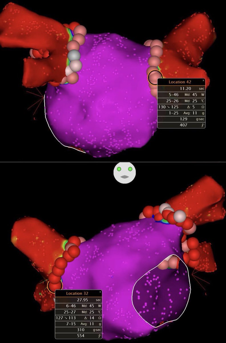 CarinaHardy4's tweet photo. Today our Incor team performed the first two #surpoint ablation in Brasil, and I made my first surpoint ablation with #zerofluoro
#AFIB #EPteamIncor #Epeeps @MuhieddineC @Scanav1Mauricio @crpisani , Sissy and #Epfellows
Thanks all team #BiosenseWebster https://t.co/FmZHGsluxB