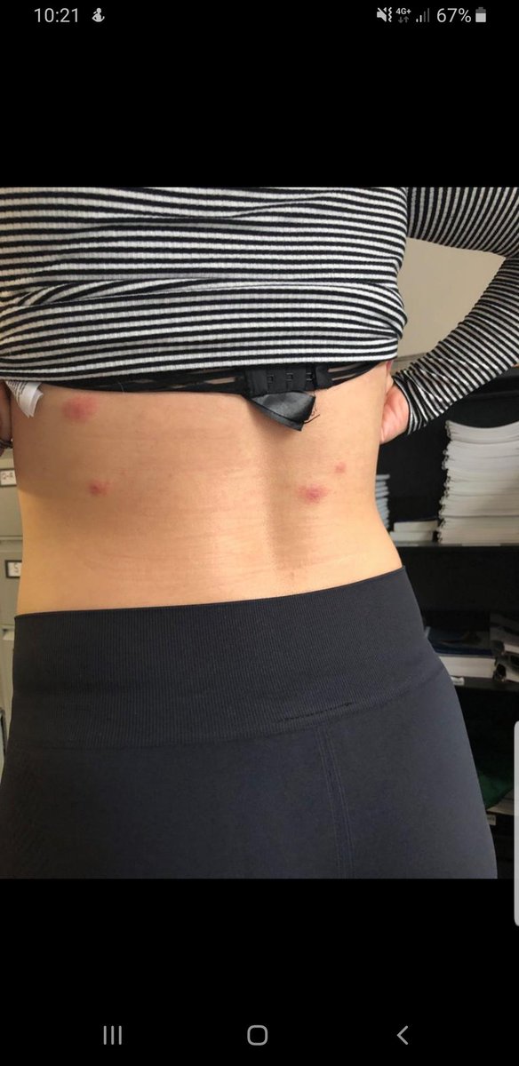 Gregg Travers (@gtravers90) on Twitter photo A colleague of mine recently stayed <a href="/premierinn/">Premier Inn</a> Nottingham West and apparently, after investigation there aren't any signs of bed bugs. Ill let you decide from the pictures...
Even after complaints made directly to the hotel, they are adamant it is a detergent from the bedding 🤔 A colleague of mine recently stayed <a href="/premierinn/">Premier Inn</a> Nottingham West and apparently, after investigation there aren't any signs of bed bugs. Ill let you decide from the pictures...
Even after complaints made directly to the hotel, they are adamant it is a detergent from the bedding 🤔