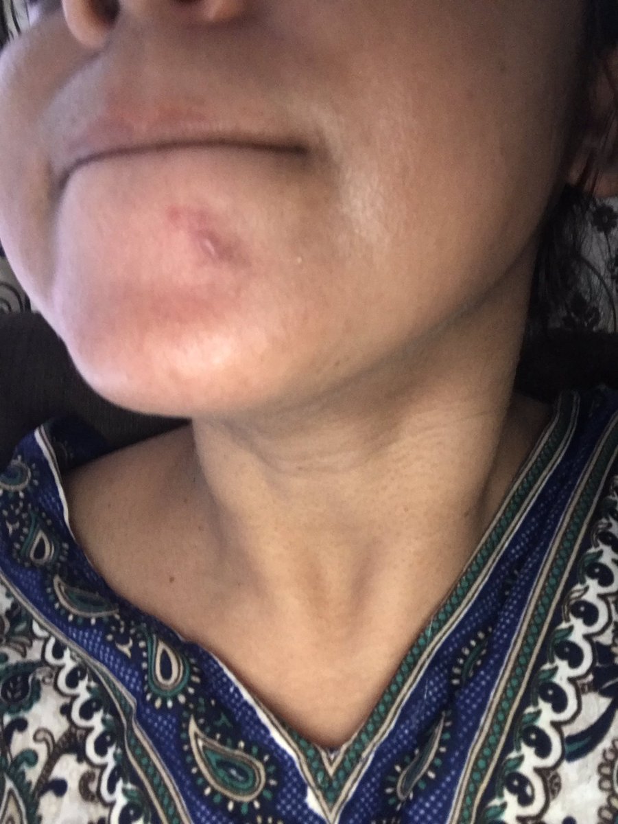 rajeshreevp's tweet image. @UrbanClap i am left with this scar ure detan is horrible i am a breast feeding mother and cant take antibiotics thanks to ure horrible service #urbanclap #servicefailure #zeroquality