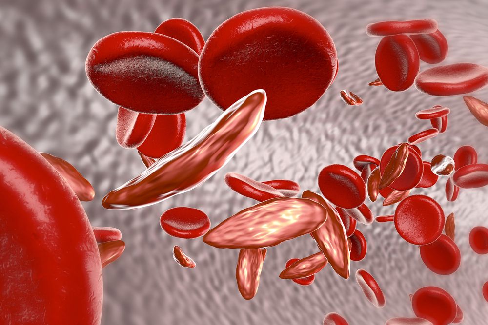 LynnInstitute's tweet photo. A Sickle Cell disease study is now enrolling participants at our Tulsa location! Receive compensation for your time and travel and expert study-related medical care at no cost. Call (918) 619-6410 or visit https://t.co/gsZyfKN6sn for more information! https://t.co/sTuvFwFzZX