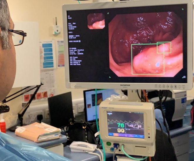We were privileged today to be the first Trust in the UK to use the new #ArtificialIntelligence platform from <a href="/Medtronic/">Medtronic</a>, GI Genius. Increases in ADR expected soon! We will demonstrate the system at <a href="/kingslivelondon/">King's Live</a> and continue to gather our experience in real world use