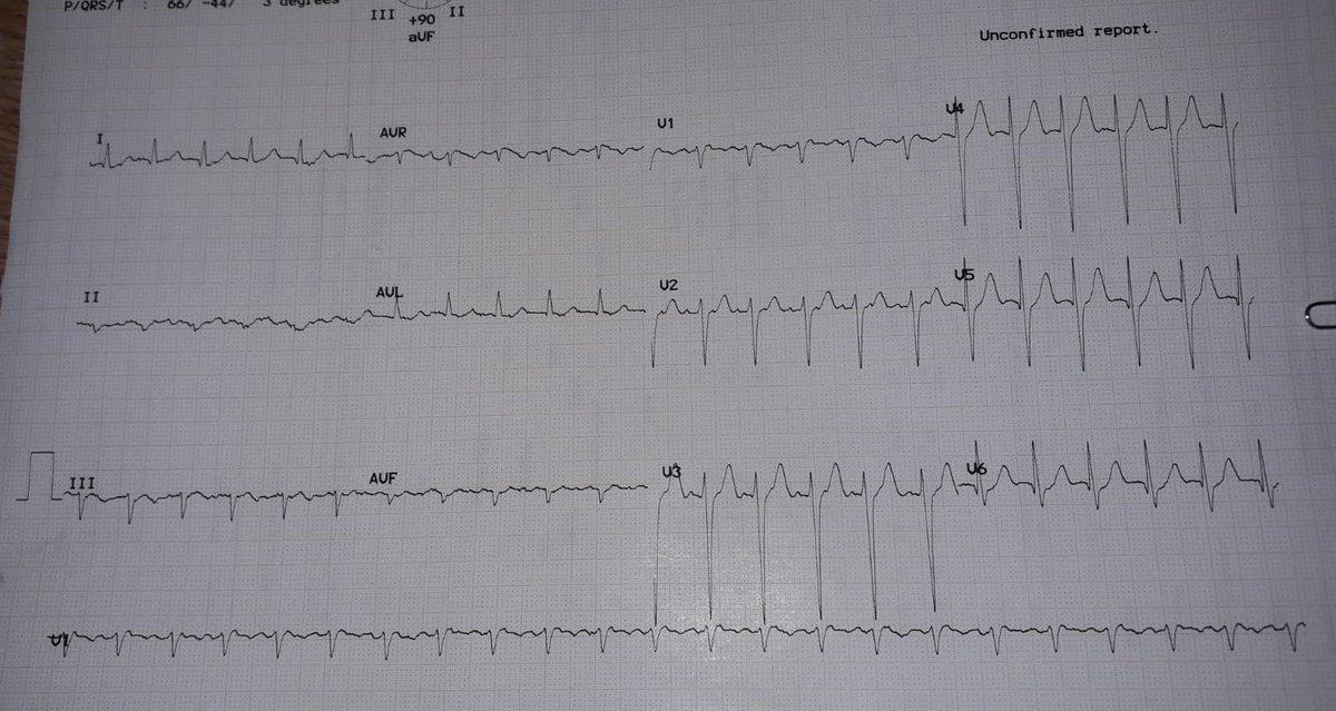 Hello BARRA wee meet again...Oor Shottie Noo....Deteriorating Patient begins....ABCDE & News2 ✅ ECGs demystified ✅ ILS tomorrow @moggie39 @JerryMorse_sim @CSMEN1 @NHSG_ACA @NHSGrampian @SimulationTrai2 #reallyremote #MDTtraining