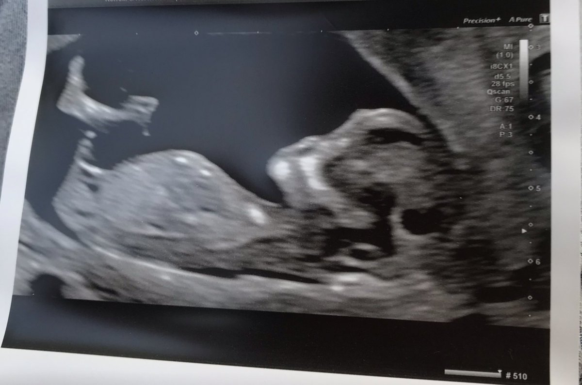 karnold2707's tweet photo. Exciting times...Baby Elliott is happening! Already practising those corner kicks. @ctell10 https://t.co/fZBBDRTTD5