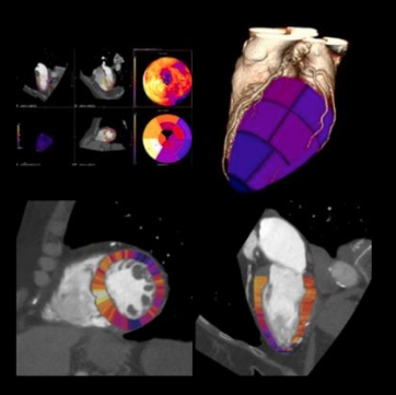 DAICpublisher's tweet photo. On-Demand CME Webinar: #Myocardial #CTPerfusion – a comprehensive appraisal of patient selection and technique in a multimodality imaging environment.  Presenter: Dr. Ron Jacob, @LGHealth PENN Medicine https://t.co/Yo4RQyF66O  @Heart_SCCT @CanonMedicalUS @DAICeditor #cardiacCT https://t.co/bnp4nINhIO