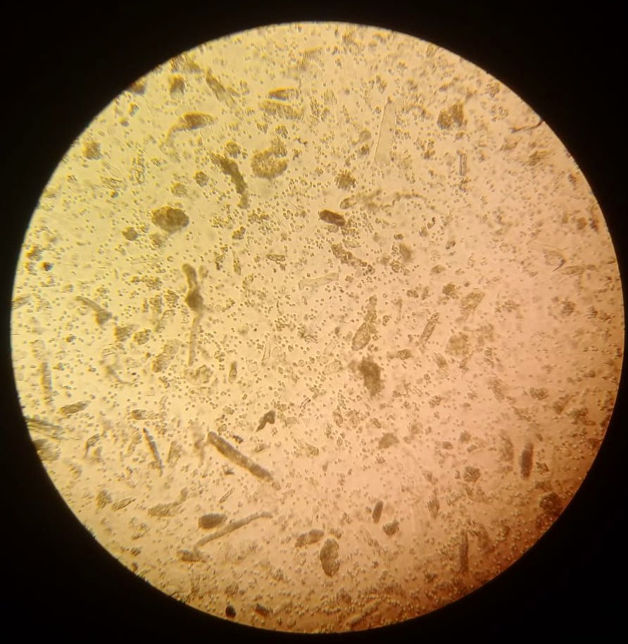 NefrologiaINC's tweet photo. Granular casts.
#AKI
#UrinarySediment #UrinaryMicroscopy https://t.co/7rYaY2xsqO