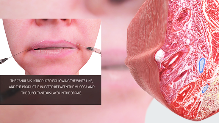 sciencestanding's tweet image. The #3DFacialProceduresApp presents middle third Volumization &amp;amp; Rejuvenation techniques in 3D to demonstrate anatomical danger zones for injection locations of the face. Explore other features: bit.ly/2FxcpHg

#FacialAnatomy #Dermatology #Ophthalmology #PlasticSurgery