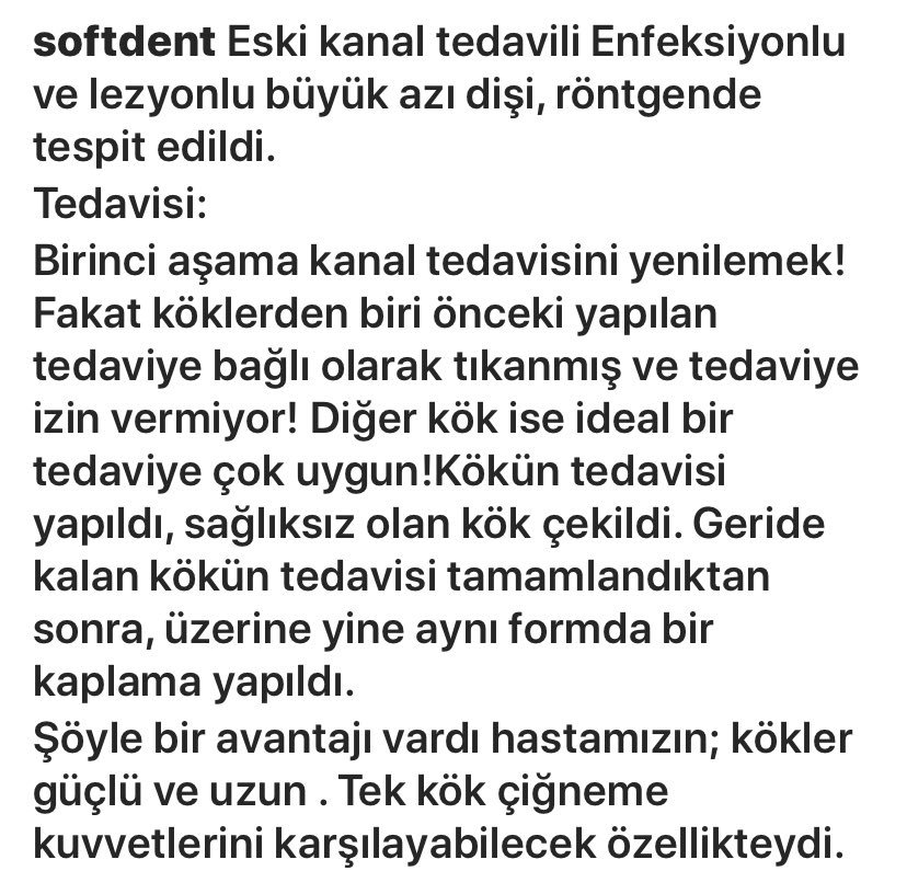 softdentubakerm's tweet photo. #Enfeksiyonlu ve bir çok tedavi engeli olan dişleri ağızda tutmak mümkün mü? Alternatif #tedaviler var mı? Her zaman uygulanabilir mi? #İmplant mı diş mi? .... #kanaltedavisi #dişseviyoruz https://t.co/mwKqPuXDBZ