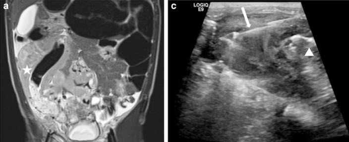 PedRadJournal's tweet image. Cases series describing technical success of percutaneous #imageguided biopsy of #bowel masses - another technique to get at hard to reach lesions, inaccessible by other techniques
ow.ly/CH8750vrwk5
#PedsRad @socpedsir