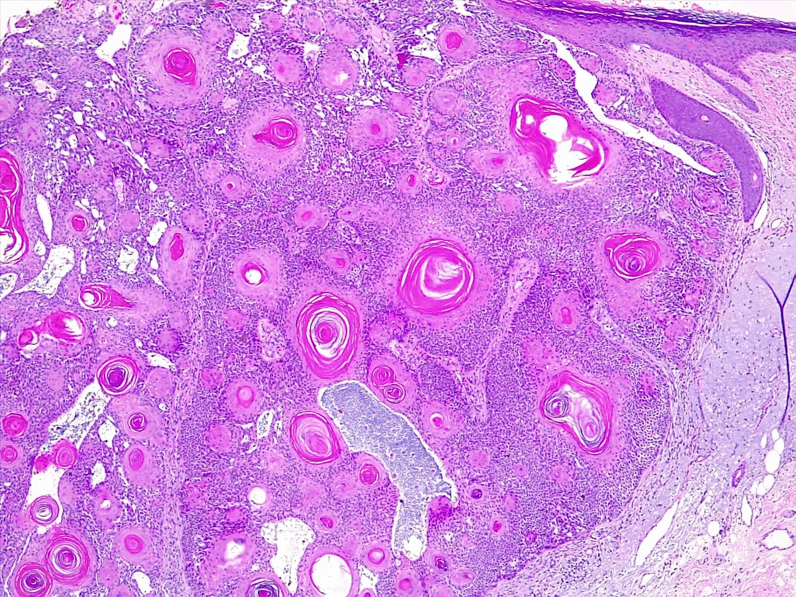 Tumor of follicular infundibulum Histology