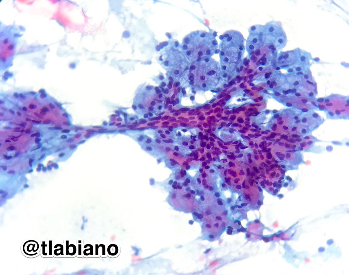 tlabiano's tweet photo. Acinar clusters connected by ducts- Cells w/ small and dark nuclei peripherally located-  Normal parotid salivary gland tissue #cytology I can’t stop looking; I cannot resist taking pictures🍇🔬💗#cytopathart #cytopathologists #cytopath https://t.co/O4y28Ppjn4