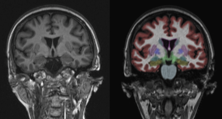 ProscanNaples's tweet photo. NeuroQuant is software that analyzes a brain MRI to improve early detection &amp; treatment of dementia, Alzheimer's disease, traumatic brain injury, multiple sclerosis &amp; epilepsy.  Proscan Imaging 3T MRI is the only center is SW FL performing this exam. For more info, call 598-0035. https://t.co/5967GKuGgK