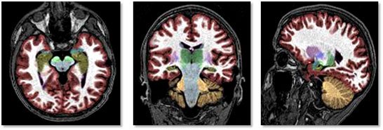 ProscanNaples's tweet photo. NeuroQuant is software that analyzes a brain MRI to improve early detection &amp; treatment of dementia, Alzheimer's disease, traumatic brain injury, multiple sclerosis &amp; epilepsy.  Proscan Imaging 3T MRI is the only center is SW FL performing this exam. For more info, call 598-0035. https://t.co/5967GKuGgK
