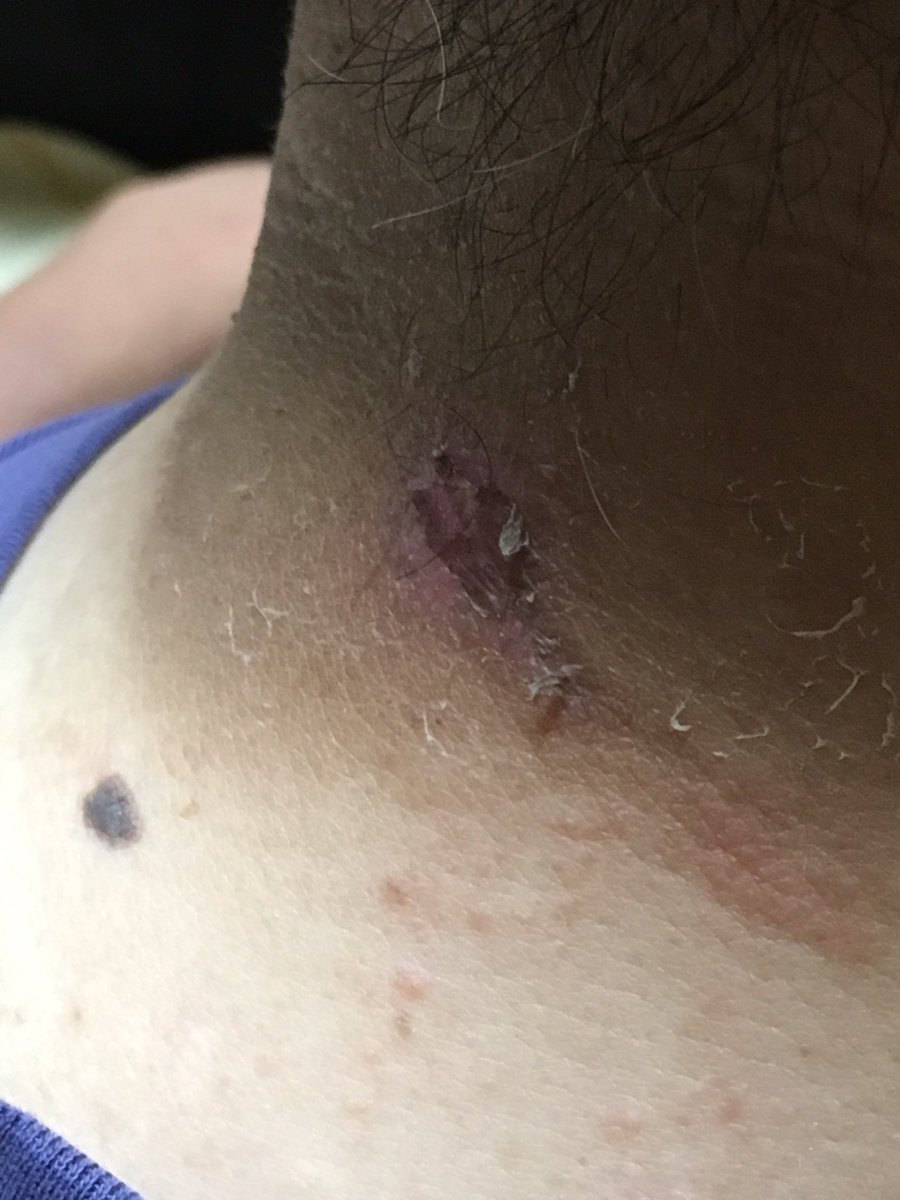 Jehuty 日焼け跡がこんなことに ﾟdﾟ あと 2 3日様子見て 病院行こうっと 日焼け 首 化膿