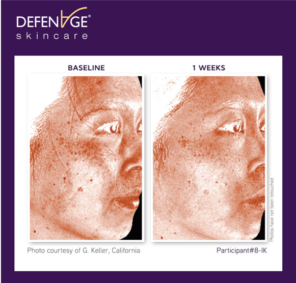 DefenAge's tweet photo. The proof is in the photos 👏 After just one week of using her #ClinicalPowerTrio, this patient saw smaller pores and fewer brown spots & sun spots and a more even tone. @KellerSurgery https://t.co/x5l1LoxwkS #HappyDefenAgeDays #DefenAgeSkincare https://t.co/hTvVscSglU