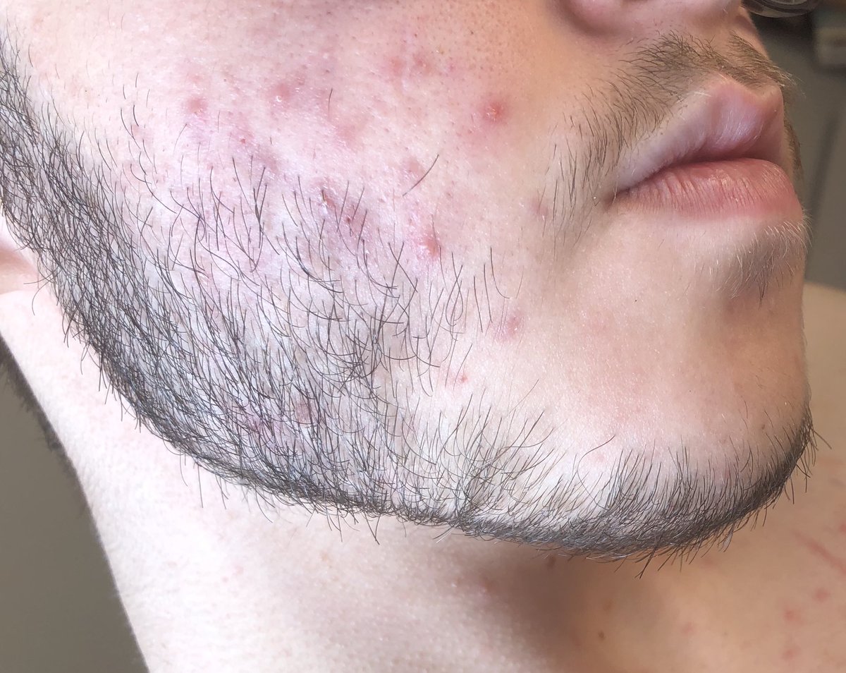 i’m gonna hit 2 years on t next month and this is what my facial hair actually looks like. right side (1st pic and 2nd pics) has less hairs than left side (3rd and 4th pics) and also more acne dkdks but i’m really happy with how it grew 