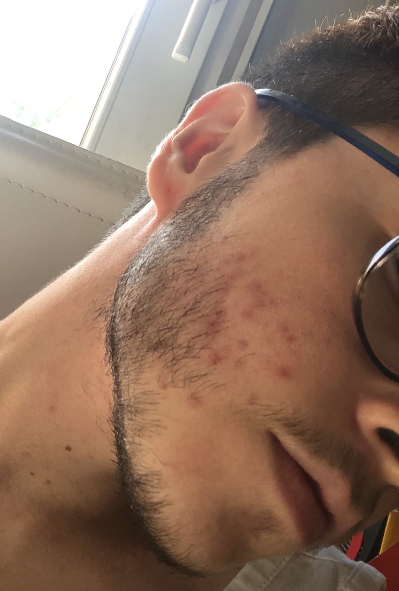 i’m gonna hit 2 years on t next month and this is what my facial hair actually looks like. right side (1st pic and 2nd pics) has less hairs than left side (3rd and 4th pics) and also more acne dkdks but i’m really happy with how it grew 